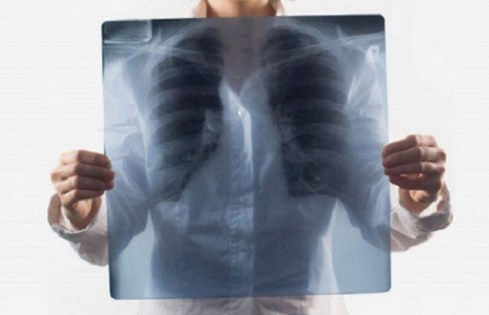Pneumonia: Simptomat, shkaktarët dhe trajtimi