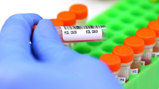 Rënie e lehtë e të infektuarve me koronavirus në Kosovë: 99 raste të reja dhe 152 të shëruar