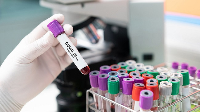 Shënohet rënie e lehtë e numrit të të infektuarve me koronavirus në Kosovë