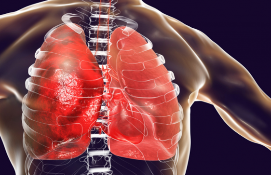 Mit apo fakt, ekspozimi i shpeshtë ndaj ajrit të ftohtë mund të shkaktojë pneumoni?!