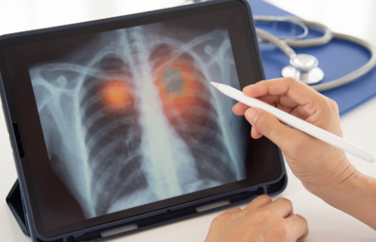 Pneumonia: Cilat janë simptomat tek të rriturit dhe fëmijët?