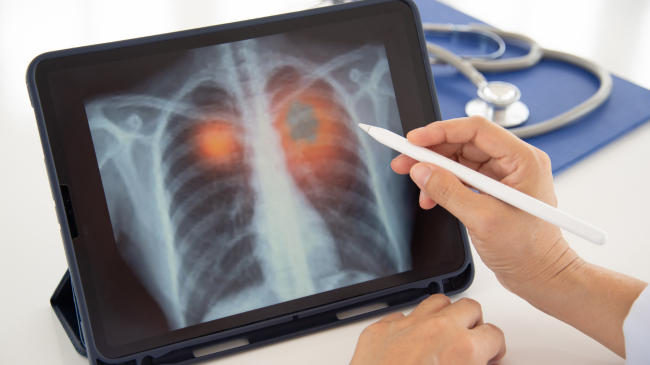 Pneumonia: Cilat janë simptomat tek të rriturit dhe fëmijët?
